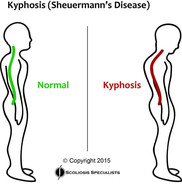 About Kyphosis